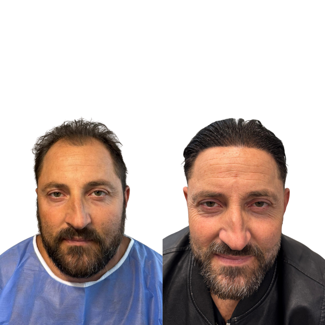 Prima e dopo trapianto capelli Nobi Hair 1