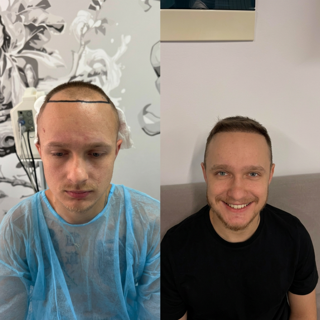 Prima e dopo trapianto capelli Nobi Hair 2