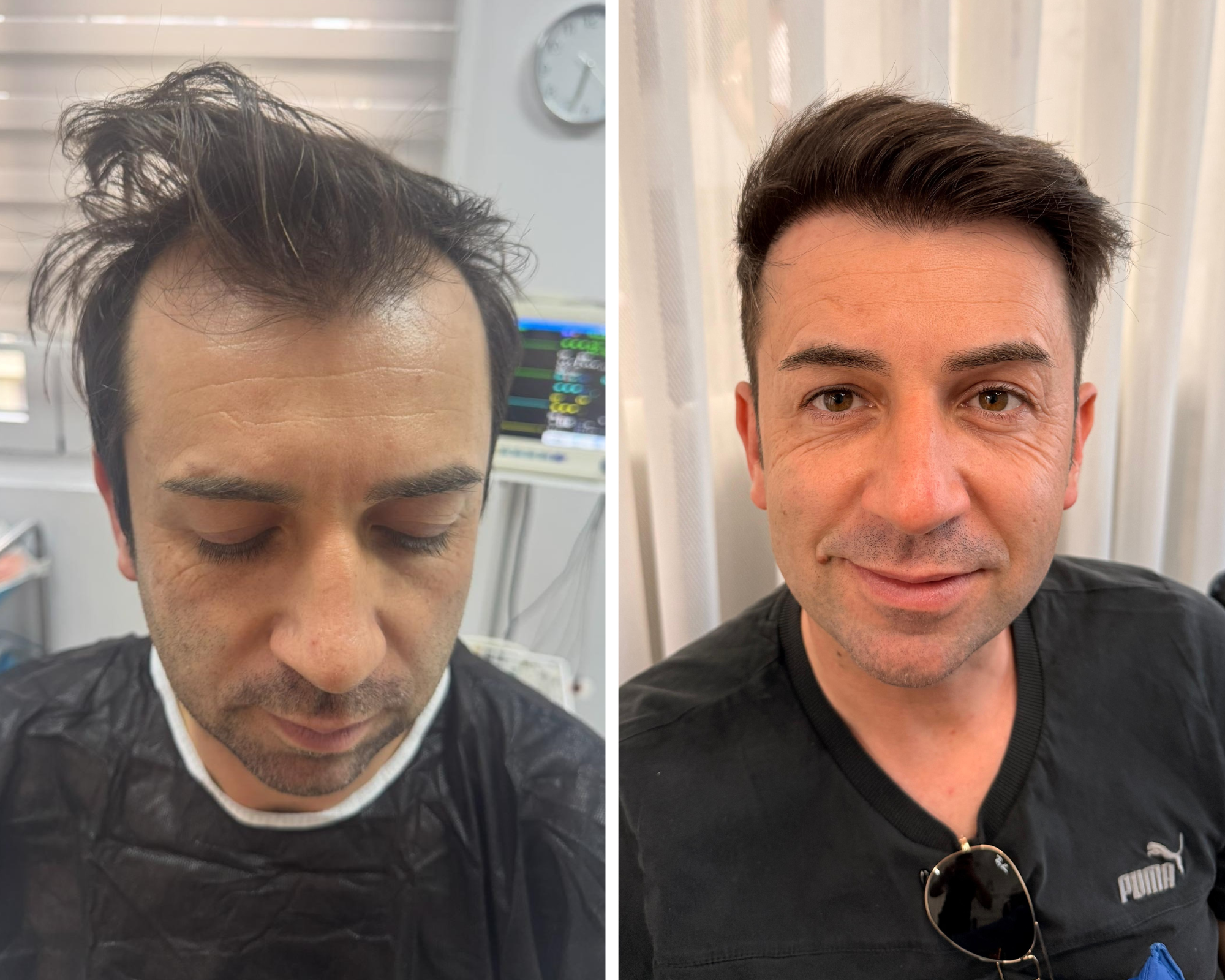 Prima e dopo trapianto capelli Nobi Hair 3